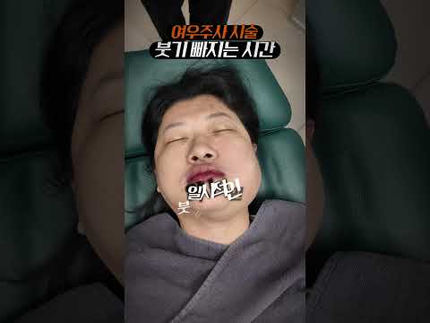 얼굴지방분해주사, 붓기빠지는 시간