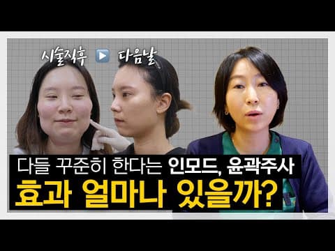 InMode & Contouring Injection Before & After