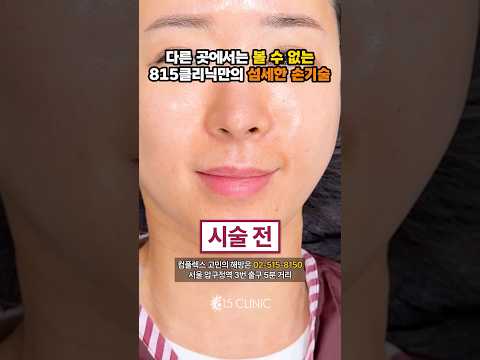 아니 이렇게 예뻐진다고!? #815클리닉 #입술필러